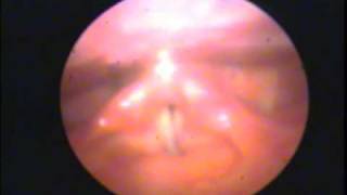 Abductor spasm — spasmodic dysphonia