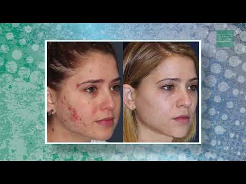 Banner for CLDerm Procedures | Acne and Acne Scarring