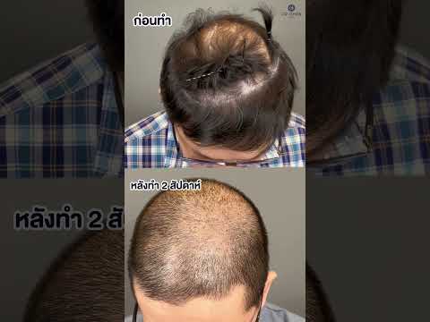 รีวิวปลูกผมเทคนิค DHI 14 วัน