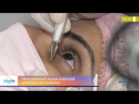 Procedimento estético ajuda a reduzir a aparência das olheiras 02 02 2021