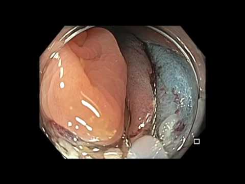 Colonoscopy: Transverse colon EMR of a subtle flat lesion