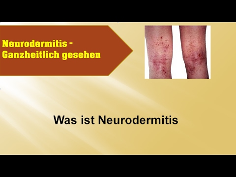 Die Pilze im Organismus und die Schuppenflechte Pegano die Behandlung der Schuppenflechte den physischen Weg zu kaufen