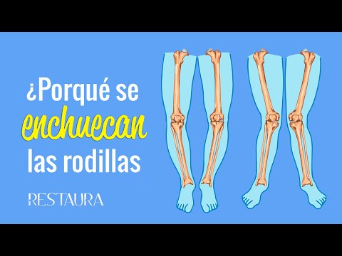 Why do knees become crooked? Genu varum - Genu valgum
