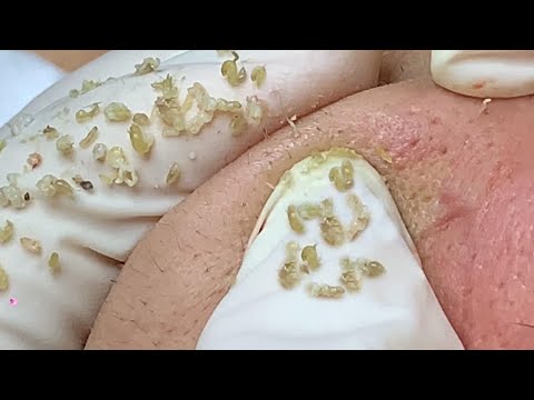 Acne Treament Under The Skin #033