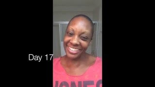 Hair Transplant FUE Recovery First 28 Days/African American/Tamrell