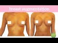 Ashley Visits Lift MD Aesthetics For A Breast Augmentation By Dr Garo Kassabian