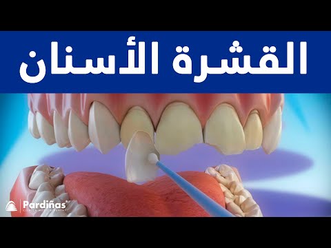 القشرة الأسنان ©
