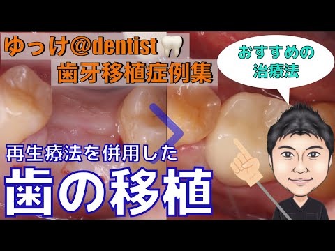 生命歯学科 【治療症例集】再生療法を併用した歯の移植について解説します！１％でも歯の移植の成功率を上げるための最新の治療法をお教えします🦷