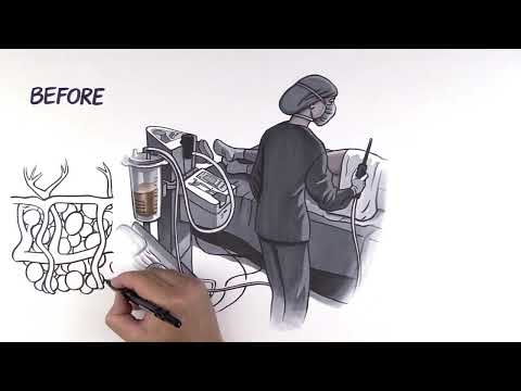 What is HD Body Sculpting?