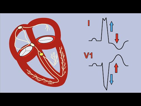 Left Bundle Branch Block and Sgarbossa's Criteria