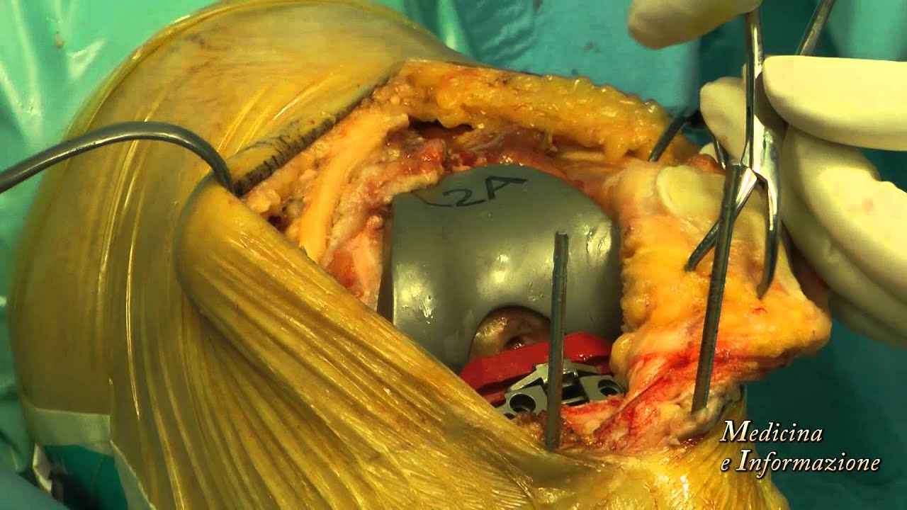 Watch Now Protesi di Ginocchio: Chirurgia d'Avanguardia con Protesi Antibiotate e Riabilitazione Protesi di Ginocchio: Chirurgia d'Avanguardia con Protesi Antibiotate e Riabilitazione