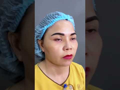Ths Bs Hải Lê nói gì về ca mũi lệch vẹo vách ngăn?