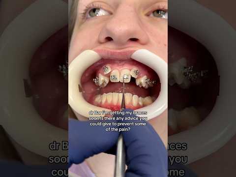 Getting Braces? Follow these Tips to Keep you out of Pain