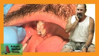 PAINFUL DENTAL ABSCESS DRAINED | Auburn Medical Group