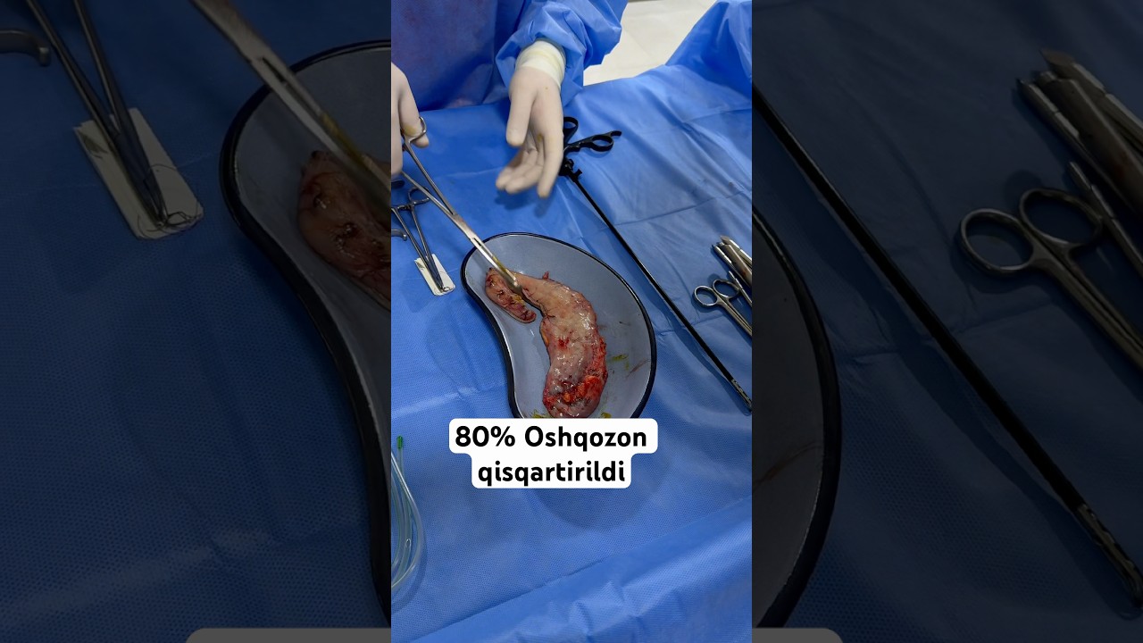 Oshqozon 80% qisqartirildi