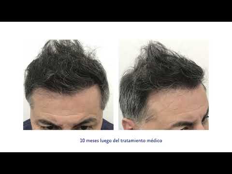 Calvicie grado 3 vertex, recuperación capilar en Capilea