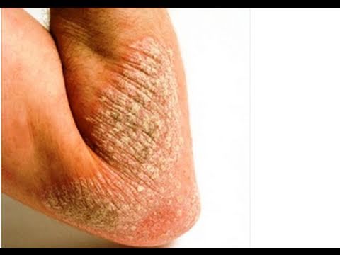 Leczema di seboreyny ad adulti come trattare Cura di psoriasi in cliniche di Togliatti