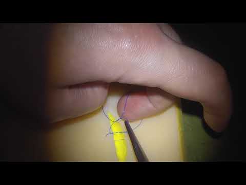 Tension relieving surgical knot