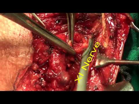 Modified Radical Neck Dissection