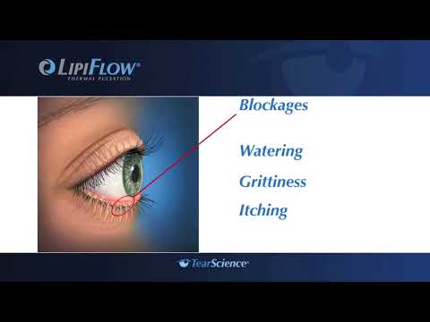 Lipiflow   Dry Eye Therapy at the Gavin Herbert Eye Institute, UC Irvine