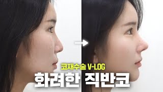 #코재수술 후 완성된 에겐녀 무드
