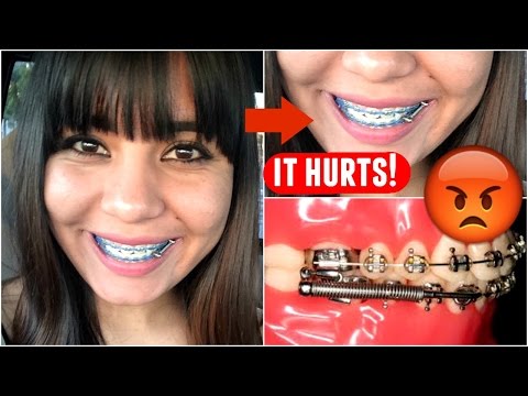I CRIED ,IT HURT SO BAD BRACES
