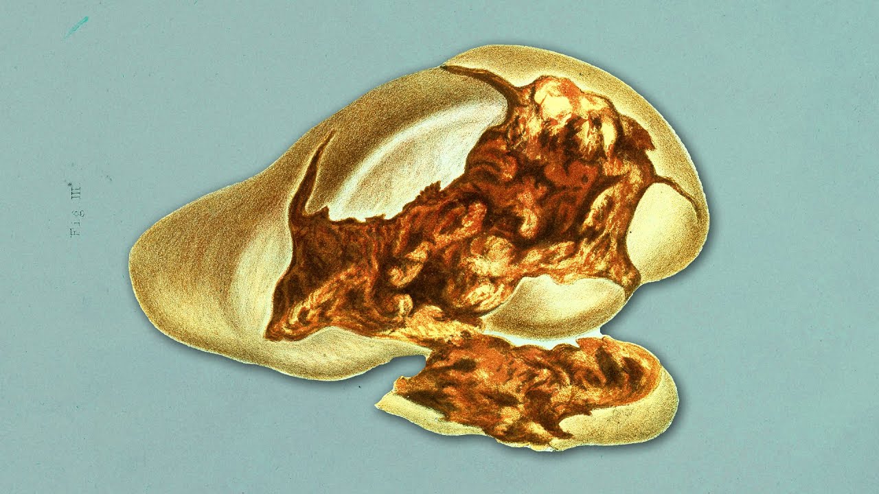 The Student Who Ate 5-Day Old Pasta And His Liver Shut Down