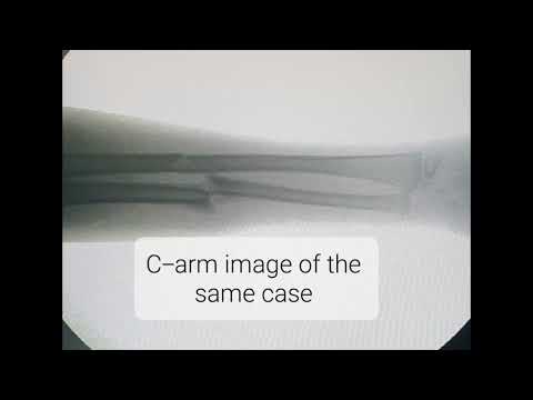 Fracture both bones Forearm | Closed reduction under Short GA | Adamya Hospital videos