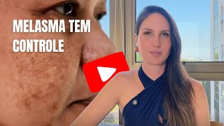 Melasma…não tem cura, mas tem controle!