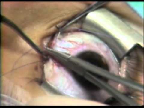 Korekcja chirurgiczna zeza: recesja mięśnia przyśrodkowego prostego- zbliżanie rąbka