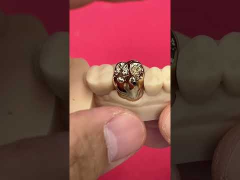 Great Tooth Retention for a Gold Crown