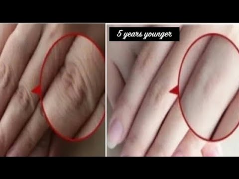Kung paano mapupuksa ang cellulite payat Nangayayat na mga larawan bago at pagkatapos ng mga tao