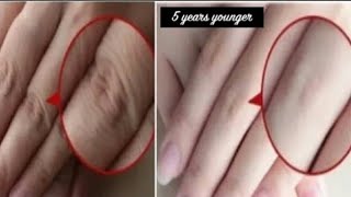 REMOVE WRINKLES Permanently, Remedy for WRINKLES, UNDER EYES, FACE WRINKLES, LOOK 10 YEARS YOUNGER