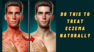 How to Get Rid of Eczema | How To Treat Eczema Naturally