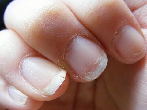 Si pasa el hongo de las uñas de los pies a las manos Los medios públicos de los hongos de árbol