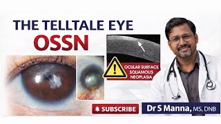 The Telltale Eye Signs of OSSN 🚨 | Ocular Surface Squamous Neoplasia Explained (