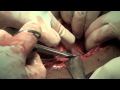 Extra peritoneal caesarean section LSCS.m4v 