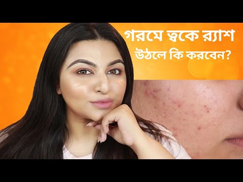 গরমে ত্বকে র‌্যাশ উঠলে কি করবেন | GET RID of SMALL BUMPS and RASHES  | Bangladesh || Ananya Artistry Video