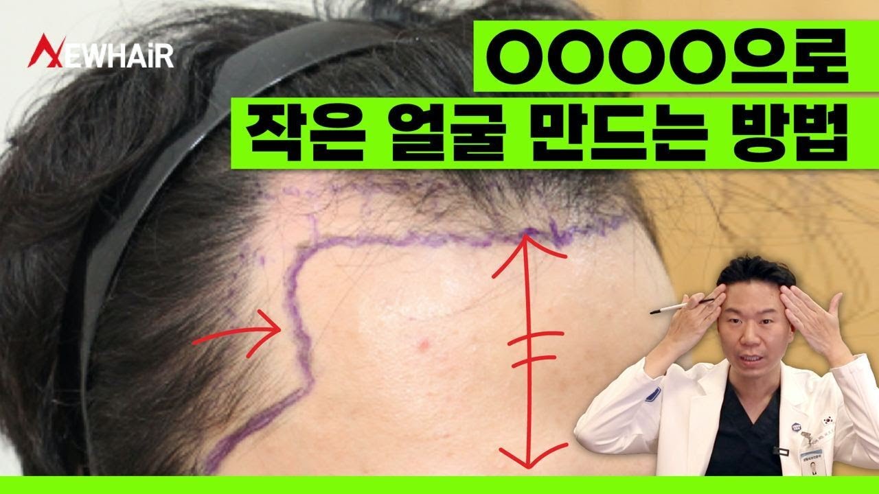헤어라인 교정 이렇게 하면 얼굴 작아집니다ㅣ뉴헤어