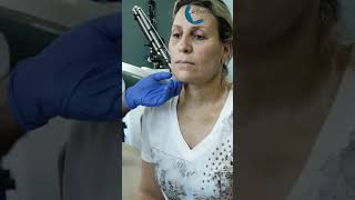 Témoignage de lifting cervicofacial nouvelle technique deepplanefacelift