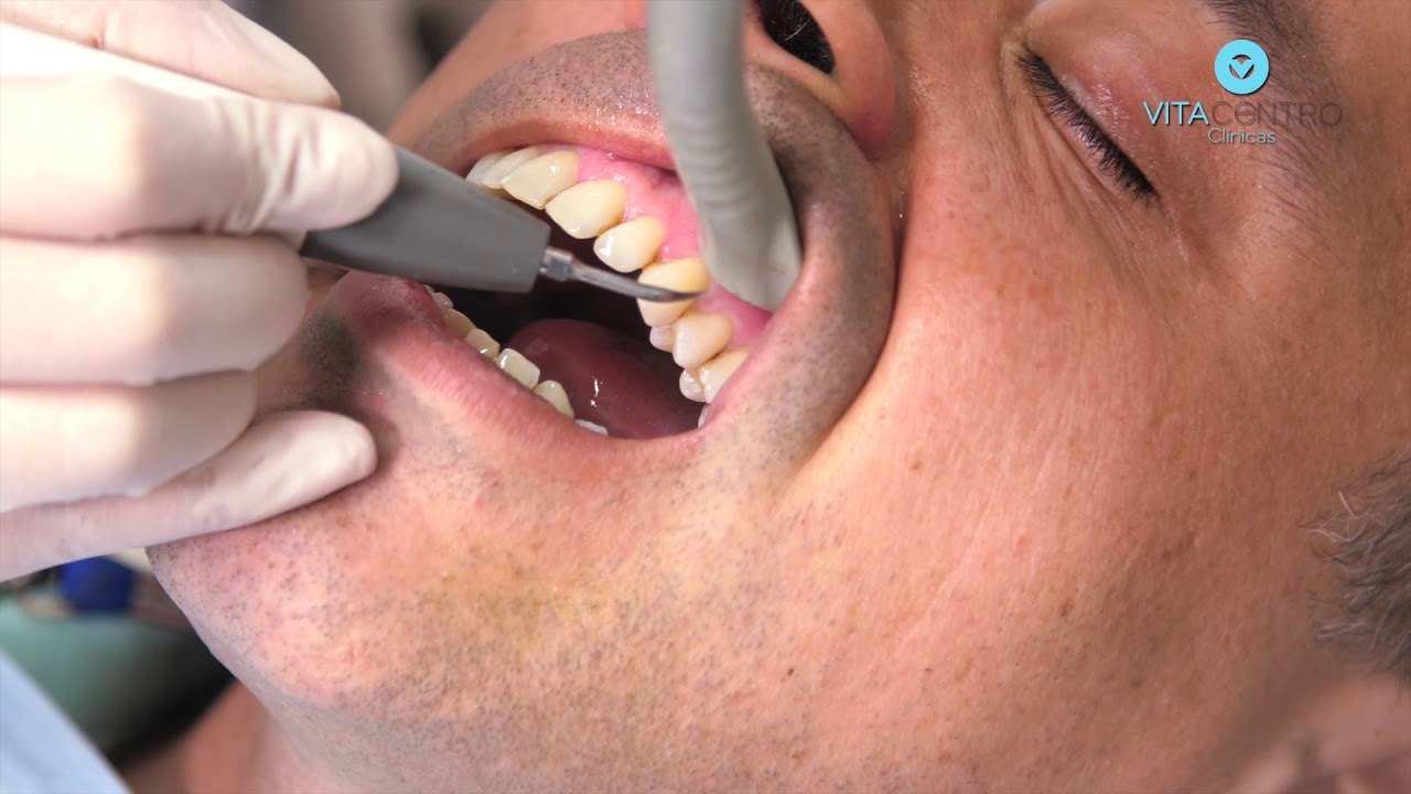 Watch Now Destartarização, limpeza dos dentes Destartarização, limpeza dos dentes