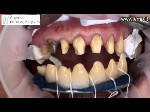 Cirkonio keramikos klijavimas su Zemfix CMP