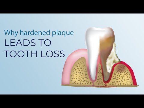 Why hardened plaque on the teeth leads to their loss