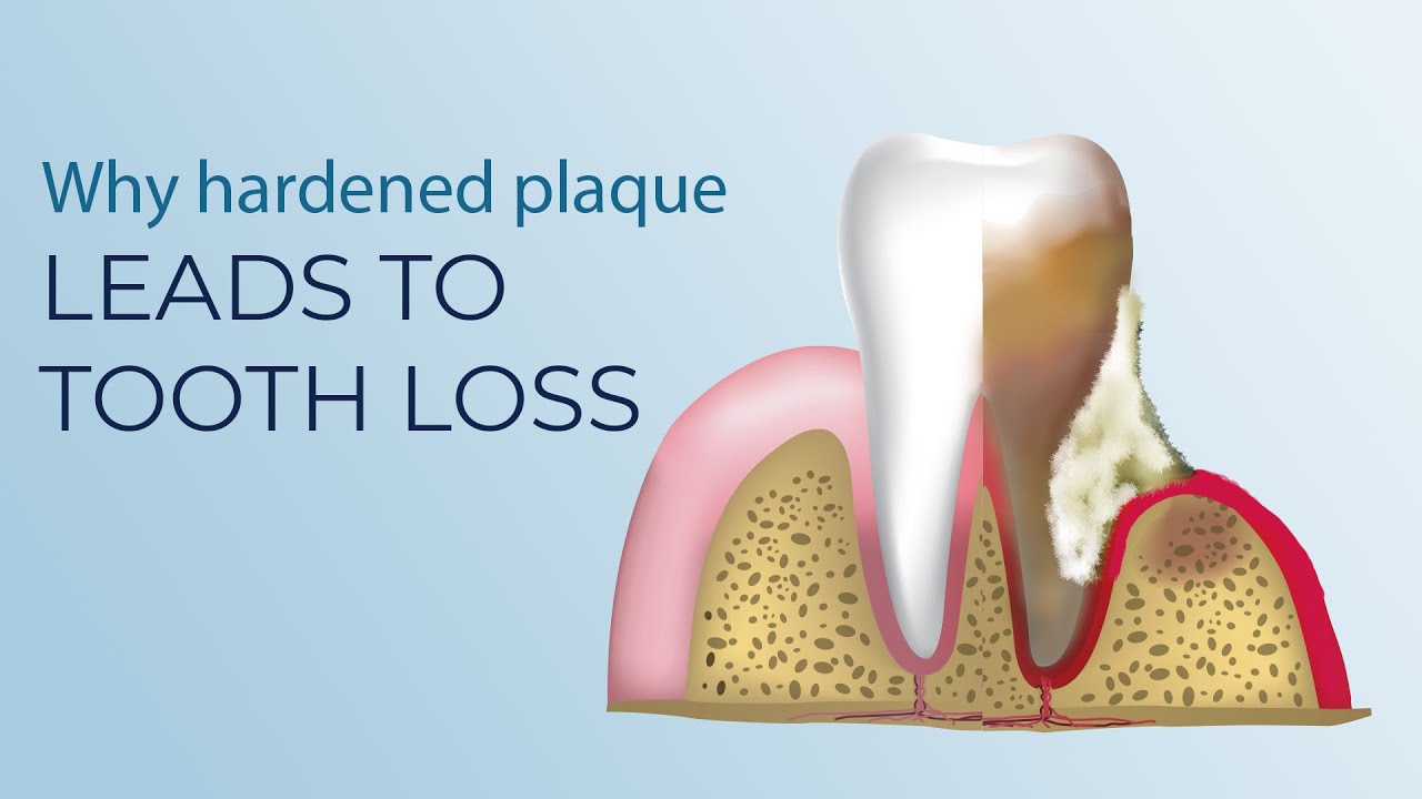 Why hardened plaque on the teeth leads to their loss