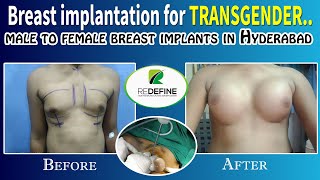 Transgender Male to Female Breast Implant in Hyder