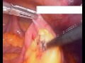 Biliyopankreatik Diversiyon Ameliyatı Ameliyatı Yüksek Kalite Ve Büyüklük Chunk 1