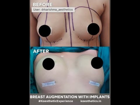Breasts Augmentation with Implants #results #boobs #shorts