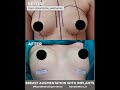 Breasts Augmentation With Implants Results Boobs Shorts