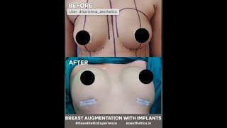 Download lagu Breasts Augmentation with Implants #results #boobs #shorts mp3