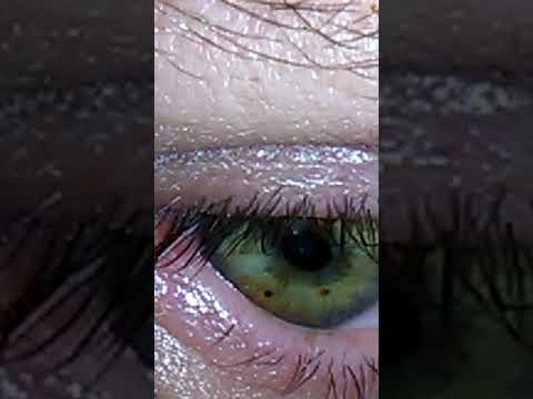 Eye lid gives birth to a morgellan  creature.